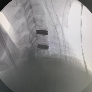 Post Op Image